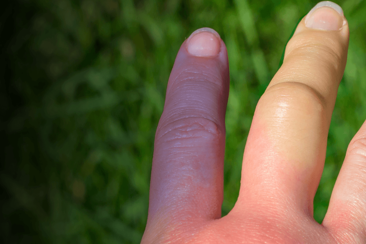 Fenómeno de Raynaud: Todo lo que hay que saber 