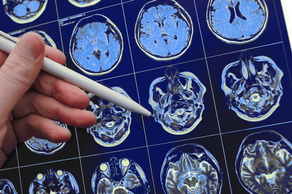 Miastenia gravis: a importância do diagnóstico precoce