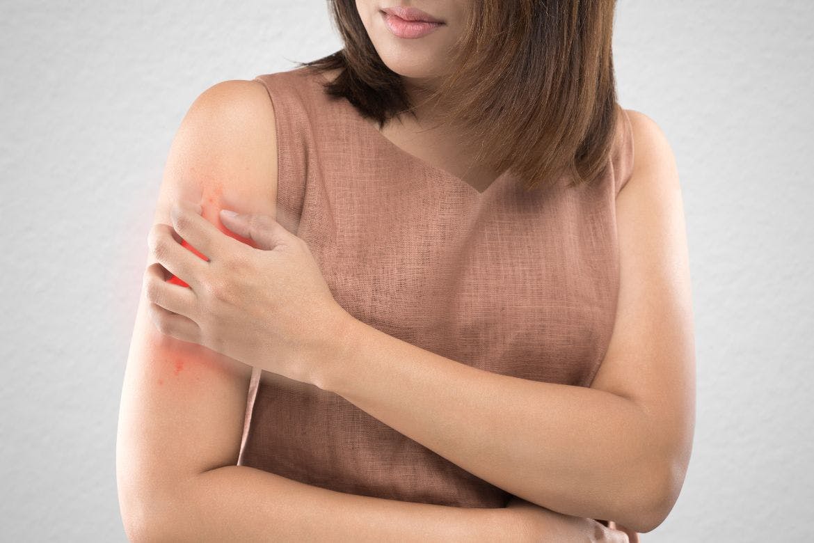 Dermatitis atópica: 1 de cada 10 adultos padece esta enfermedad de la piel