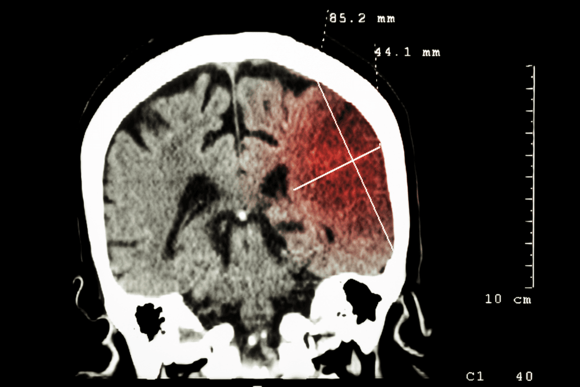 Diferencias entre infarto cerebral y embolia cerebral