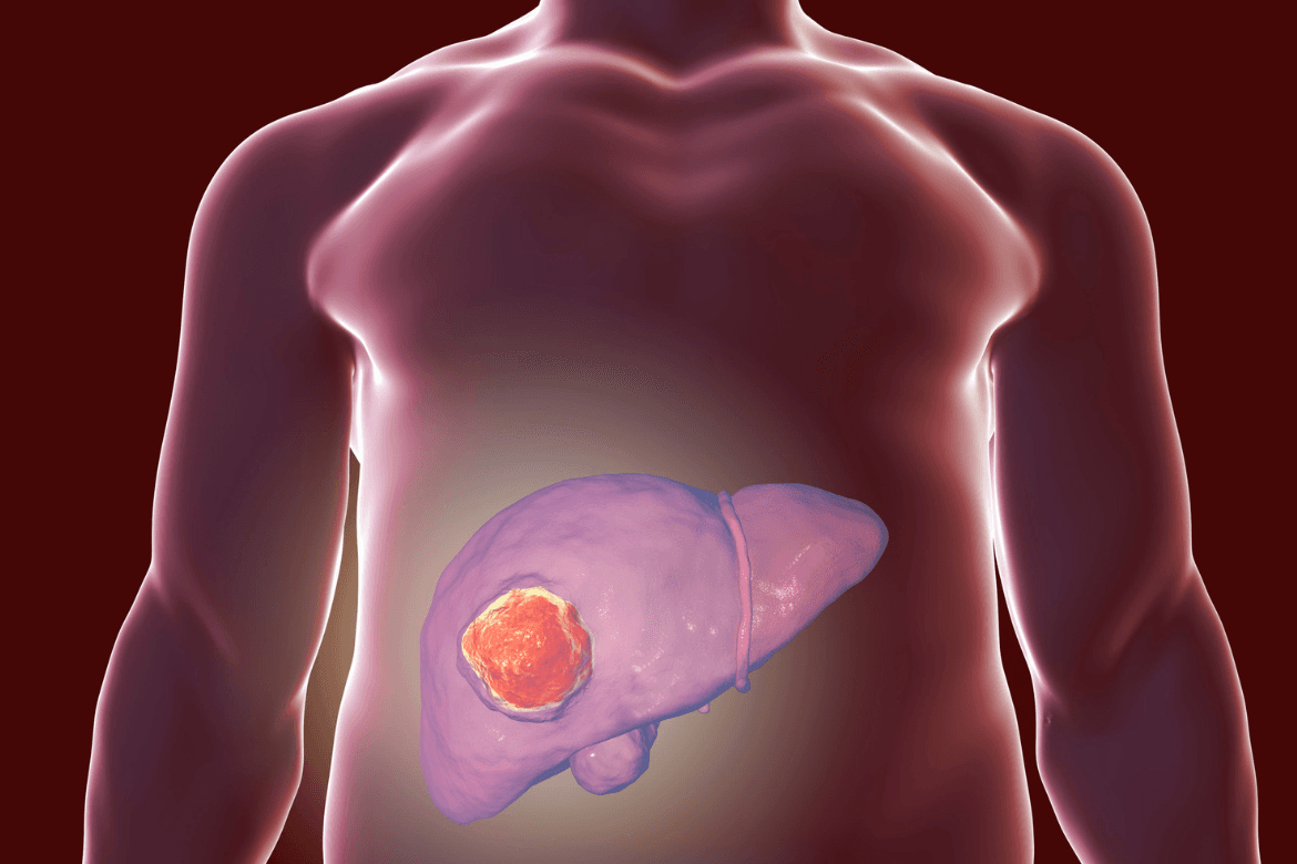 Cáncer de hígado: Novedosa inmunoterapia en investigación