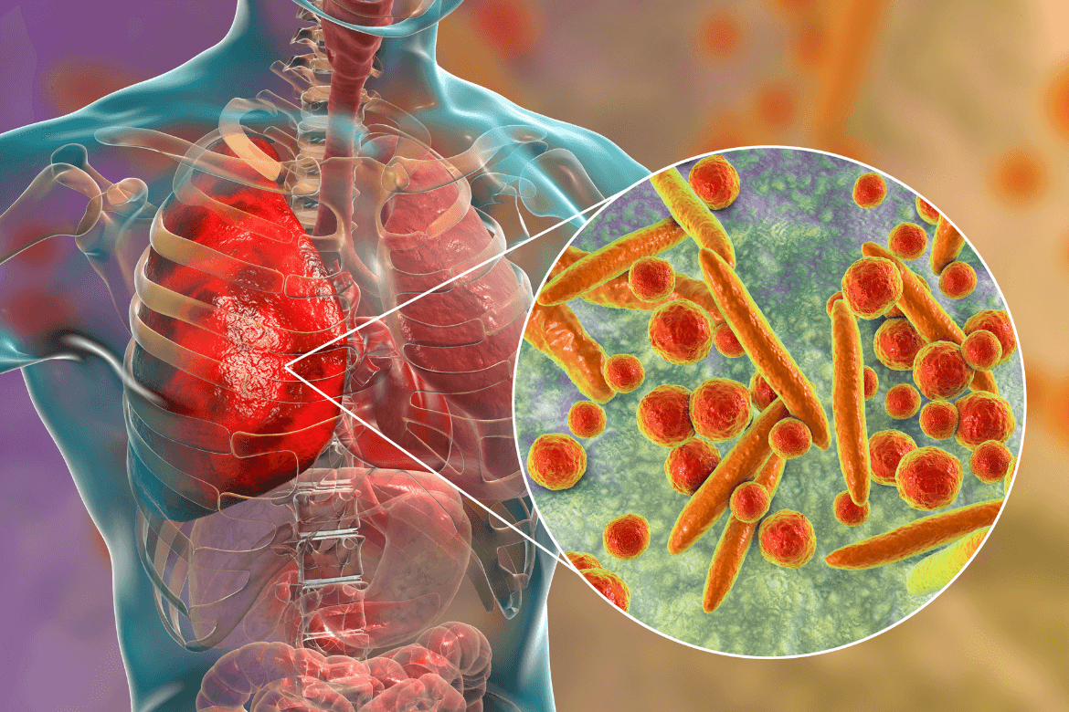 Diferenças entre pneumonia e tuberculose