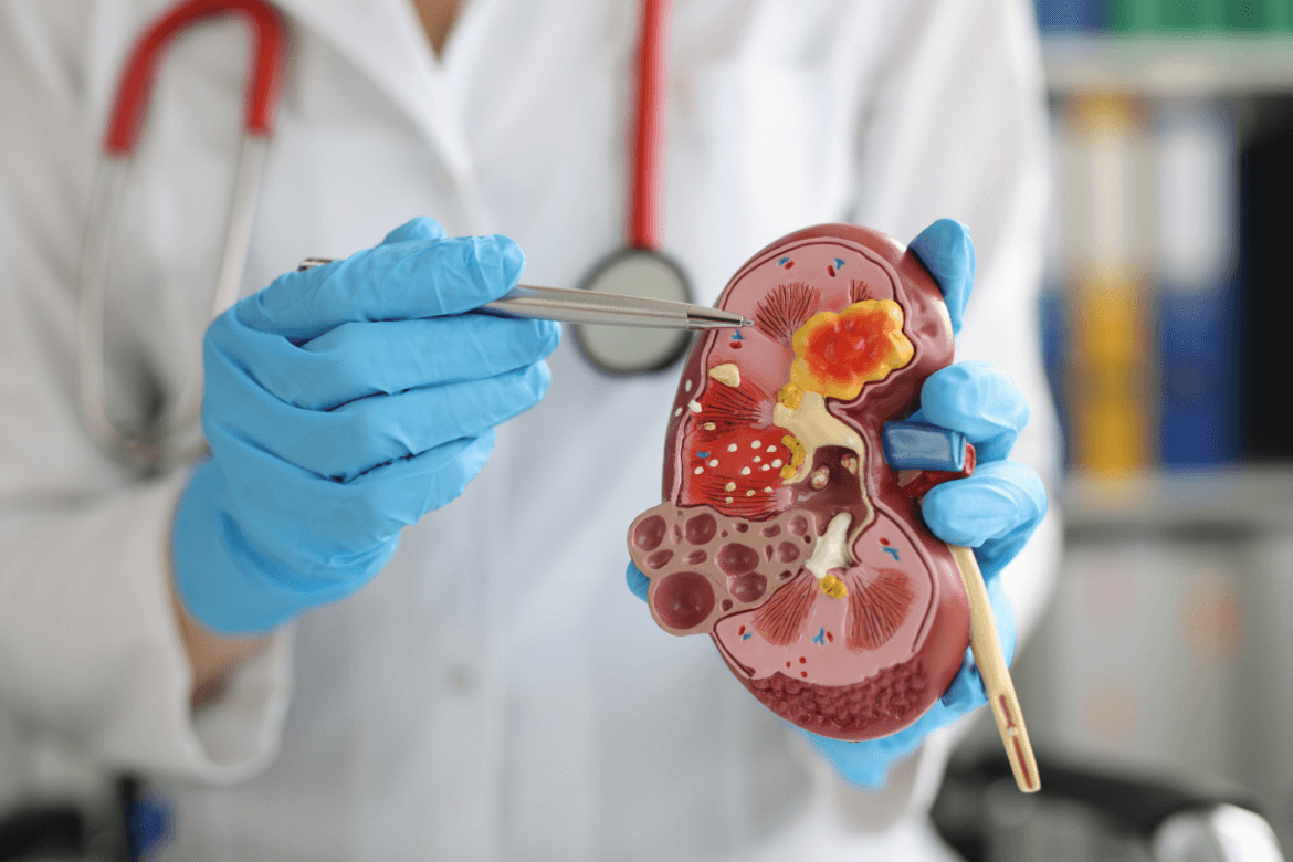 Enfermedad renal crónica: diagnóstico temprano y avances científicos