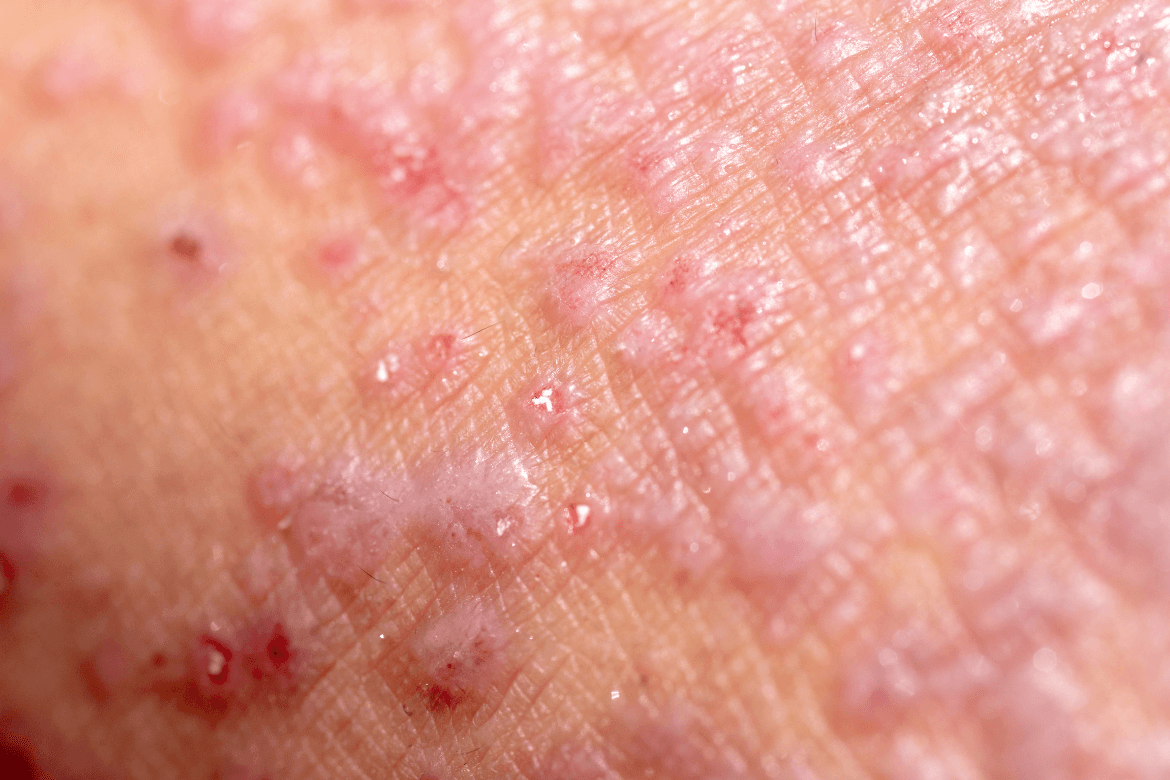 Tratamientos biológicos para la dermatitis atópica: ¿Qué debes saber?