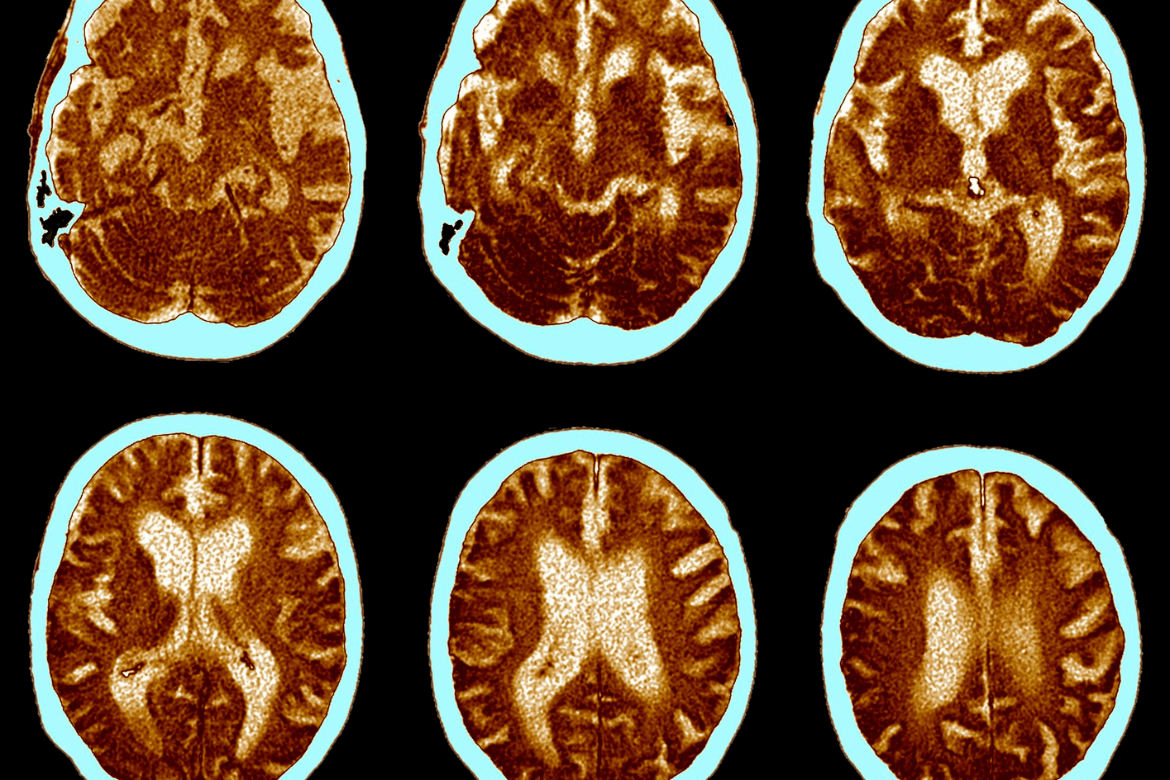 Daños cognitivos del Alzheimer: ¿cómo afecta al cerebro?