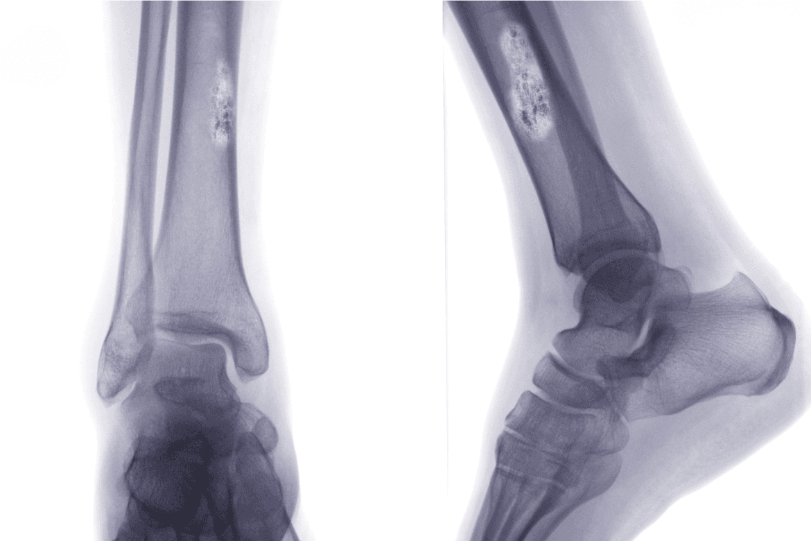 Osteosarcoma: cómo afecta a niños y adolescentes