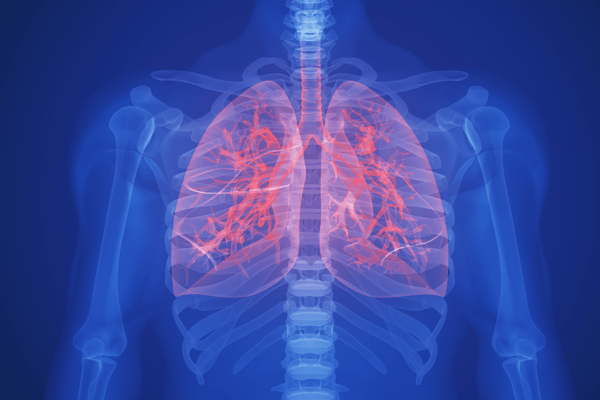 ¿La fibrosis pulmonar tiene cura?