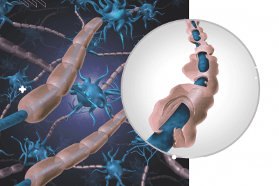 ¿Cuál es la diferencia entre la aterosclerosis y la esclerosis múltiple?