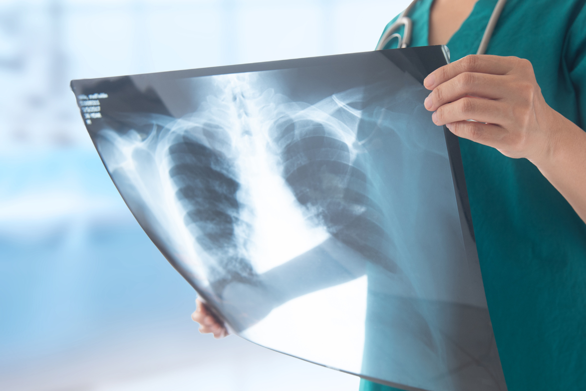 Esclerodermia y pulmones: ¿se puede evitar la fibrosis pulmonar?