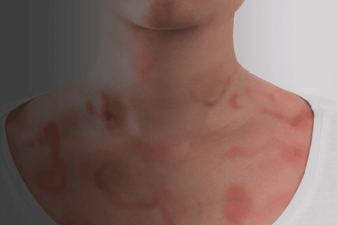 Los síntomas del lupus que pocos conocen