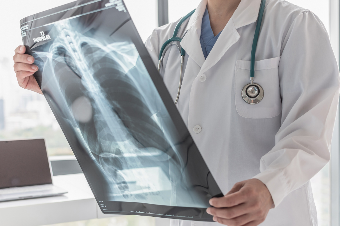 Esclerodermia e pulmões: a fibrose pulmonar pode ser prevenida?