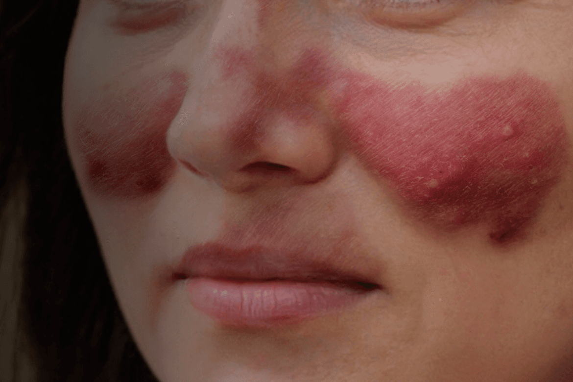 Lupus cutáneo: cómo manejar los problemas emocionales y sociales