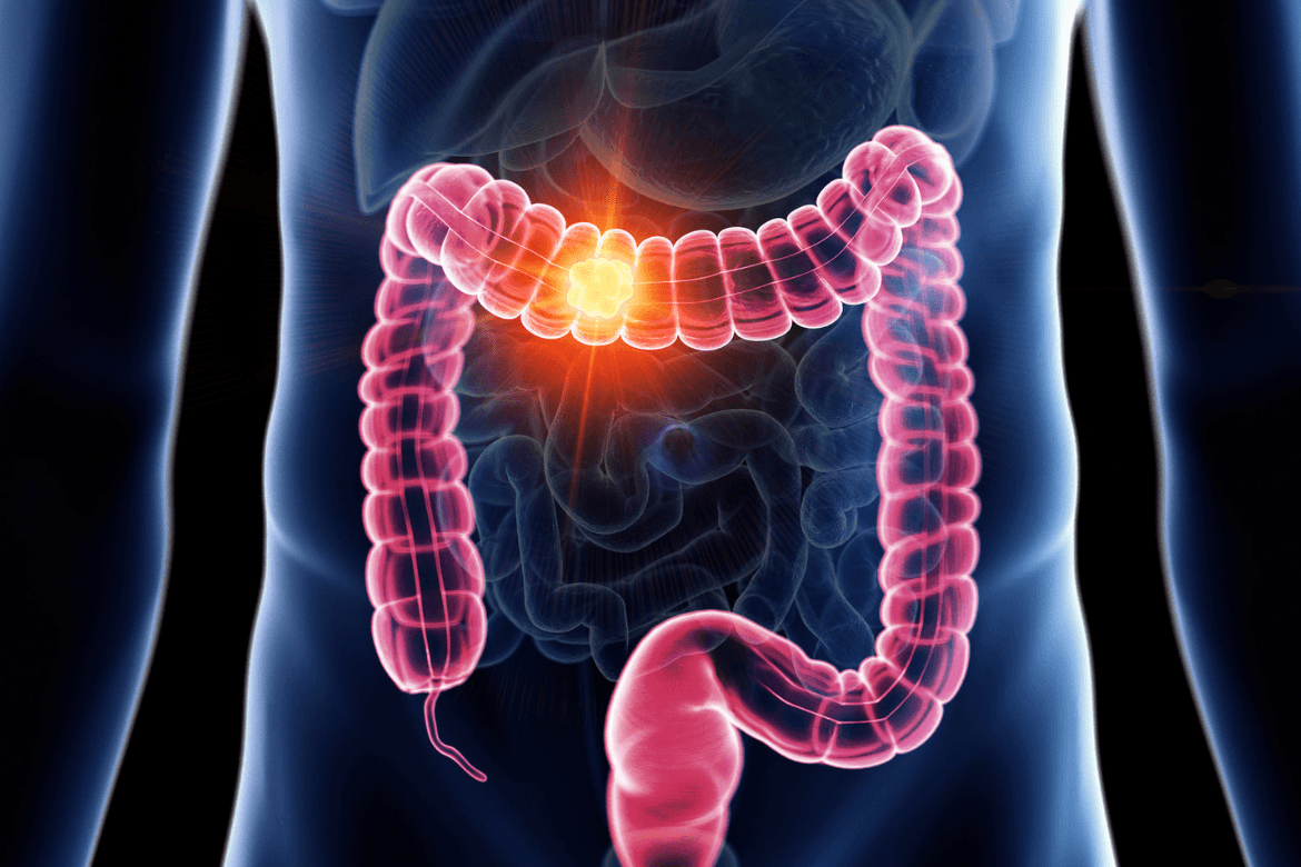 Colitis ulcerosa: investigan un nuevo tratamiento