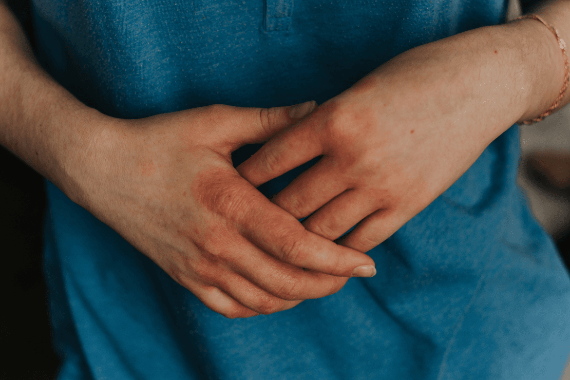 ¿Qué pasa en el cuerpo de alguien que tiene esclerodermia?