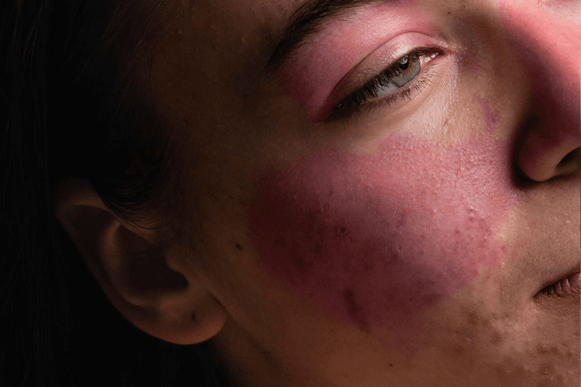 Lúpus: por que é importante falar sobre pesquisa