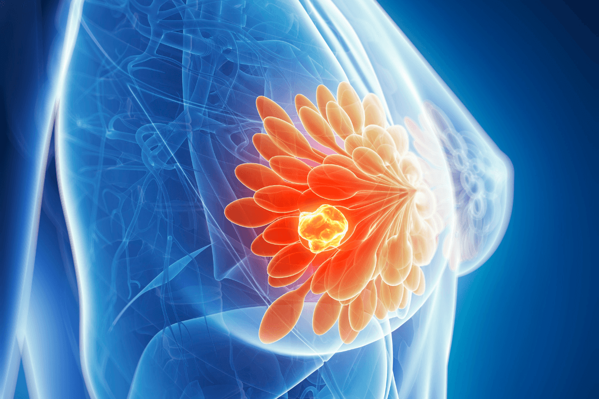 Câncer de Mama: tratamentos e avanços científicos
