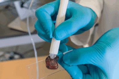 La lapicera que detecta cáncer en 10 segundos