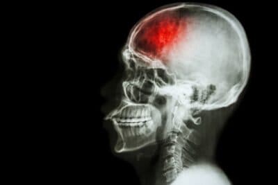 Cáries e AVC: como a saúde bucal pode aumentar o risco de derrame cerebral