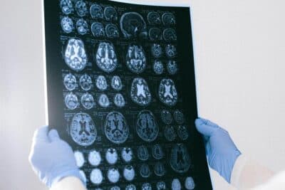 Psicose no Alzheimer: por que alguns pacientes desenvolvem delírios e alucinações?