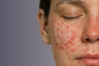 Lupus cutáneo: estudian un novedoso tratamiento