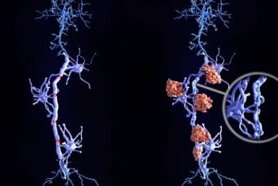 Esclerosis múltiple: un hidrogel en estudio logra regenerar la mielina