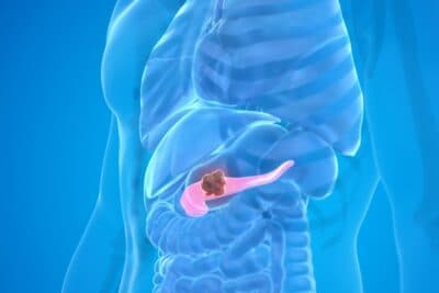 Cáncer de páncreas: una terapia dirigida logra duplicar la supervivencia en pacientes con enfermedad avanzada
