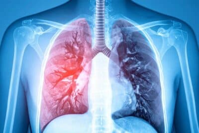 Cáncer de pulmón: investigan un nuevo tratamiento para pacientes con enfermedad avanzada